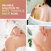 HAIR O HAIRO RELIEF - Butt & Body Acne Treatment, 100ml | Targets Pimples & Acne on Butt, Thighs & Back