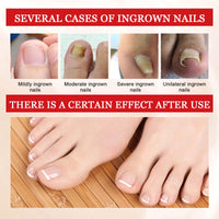 Ingrown Toenail Treatment Drop, Cuticle Care Oils for Ingrown Toenails, Trimming Toenail Softening Drops, Natural Ingrown Toenail Correction, Fungal Nail Treatment, Nail Growth Treatment, 30ml