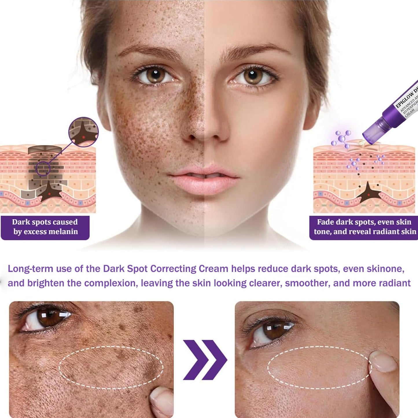 Epiglow Melanex Advanced Anti-Hyperpigmentation Cream, Dark Spot Remover for Face & Body, Pigmentation Removal Cream, Reduces Hyperpigmentation, Age Spots, Improve Skin Tone, for All Skin Types