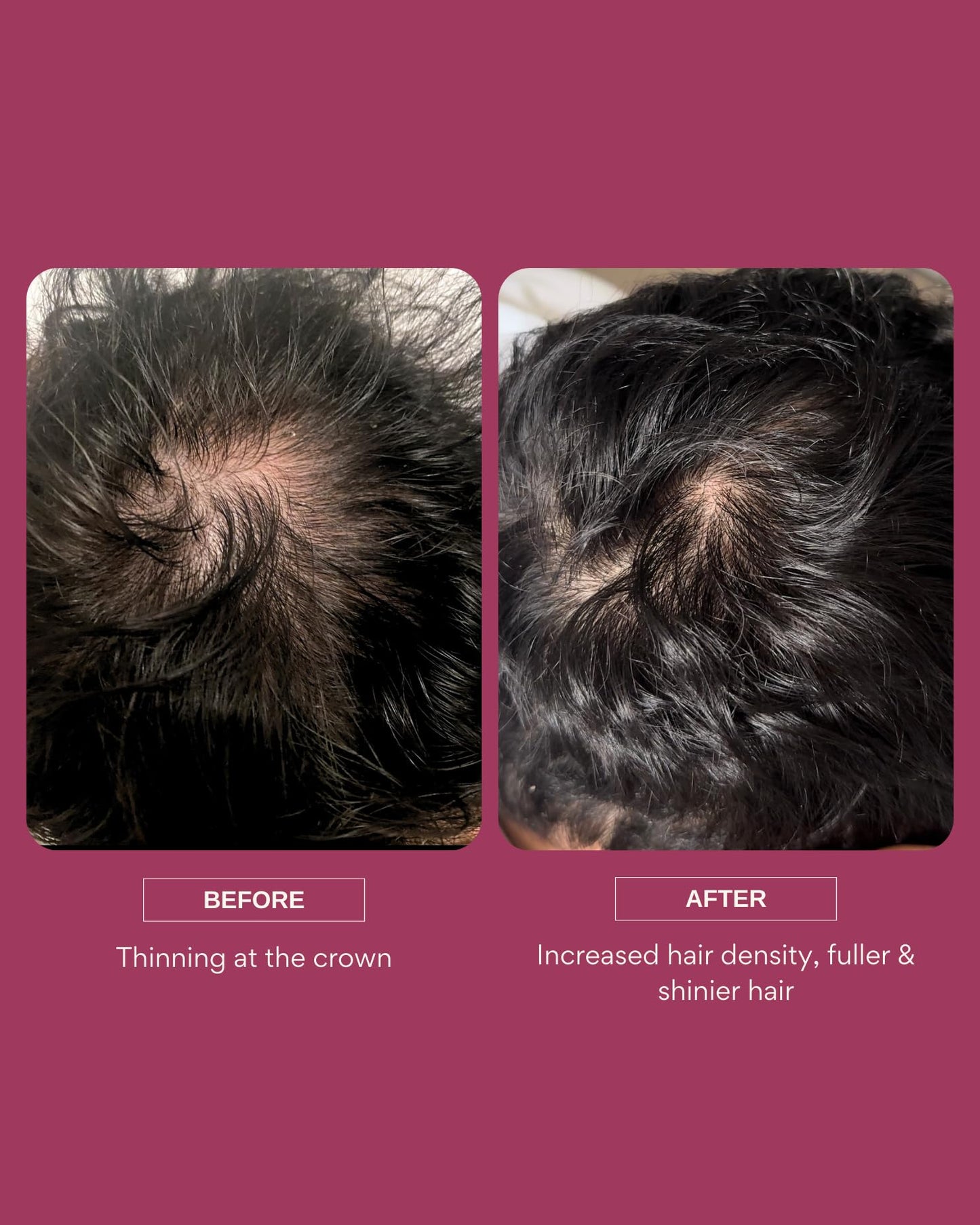 Resèt Hair Growth Serum, 50ml - Boosts Hair Growth, Targets Hair Loss & Thinning, with Caffeine, 4% AnaGain™, Probiotics, Results in 90 Days