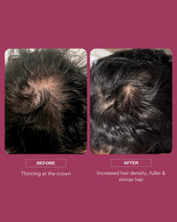 Resèt Hair Growth Serum, 50ml - Boosts Hair Growth, Targets Hair Loss & Thinning, with Caffeine, 4% AnaGain™, Probiotics, Results in 90 Days