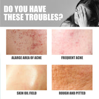 Butt Pimple Clearing Treatment Cream,Butt Acne Treatment,Butt Acne Treatment Balance Oil,Butt Acne Clearing Spot Treatment Cream,Butt Pimple Removing Cream,Butt And Thigh Acne Treatment Cream,100ml