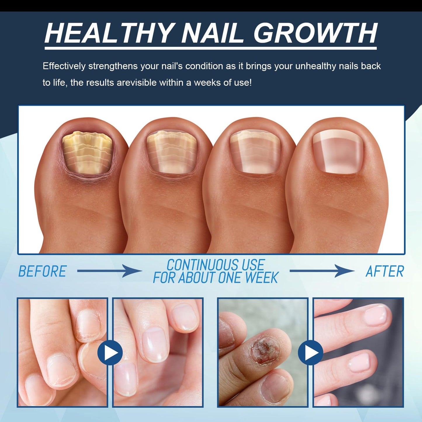 Nail Strengthener, 2PCS Revitalizing Nail Growth Serum, Nail Hardener Extra Strong and Growth - Nail Repair Serum for Damaged Nails for Faster Growth - Achieve Stronger, Healthier Nails