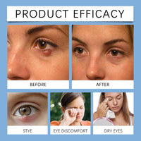 HUAIAN Chalazion & Blepharitis Treatment Eye Cream, Chalazion Eye Care Cream, Chalazion Treatment for Stye, Hydrating Treatment for Delicate Eye Area, Nourishing Blend for Sensitive Skin
