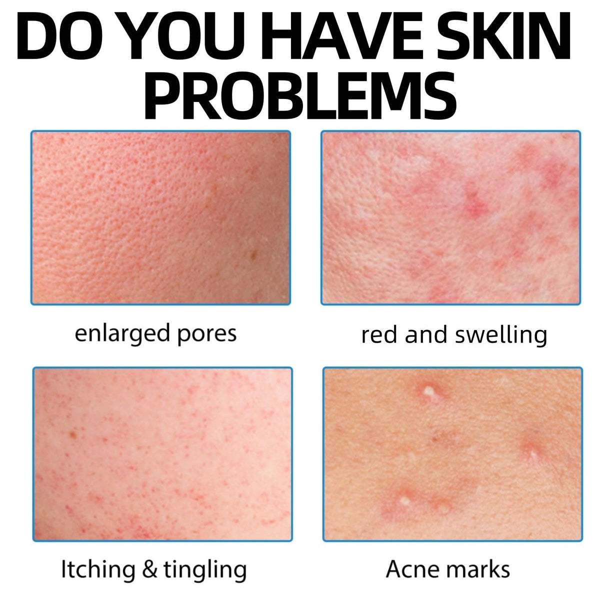 QinZiEn Acid Spot Cream,Acne Treatment for Spot Prone Skin,Acne Scar Treatment,24-Hour Spot Reduction,Acne Cream,Dark Spot Remover for Face,A/nce Scar Removal C/ream,Spot Treat/ment,15g