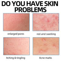 QinZiEn Acid Spot Cream,Acne Treatment for Spot Prone Skin,Acne Scar Treatment,24-Hour Spot Reduction,Acne Cream,Dark Spot Remover for Face,A/nce Scar Removal C/ream,Spot Treat/ment,15g