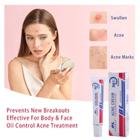 Rapid Acne Scar Treatment Cream - 24-Hour Fast Spot Reduction, Anti Acne Formula, Sensitive Skin Safe, Includes Fast Acne Scar Removal, Moisturiser, Deep Pore Cleansing - 30ml