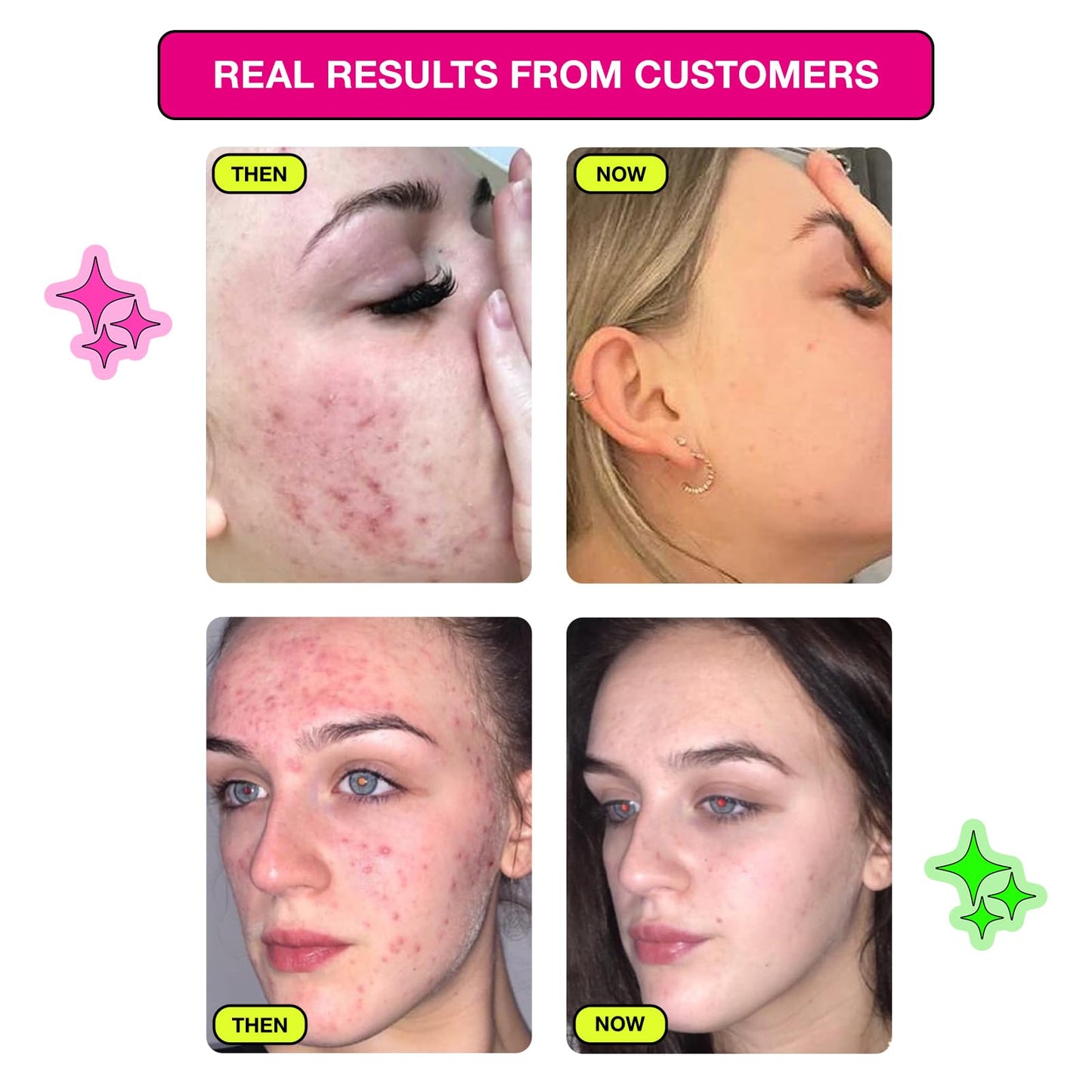 Carbon Theory Facial Moisturiser for Acne Prone Skin - Tea Tree Oil, Vitamin E, Shea Butter Moisturiser - Oily Skin Moisturiser - Vegan & Cruelty Free - 100ml