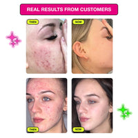 Carbon Theory Facial Moisturiser for Acne Prone Skin - Tea Tree Oil, Vitamin E, Shea Butter Moisturiser - Oily Skin Moisturiser - Vegan & Cruelty Free - 100ml