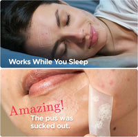 EveBeaty 240 Pcs Large Hydrocolloid Acne Patches with Tea Tree Oil, 4 Sizes & Shapes for Face, Large Pimple Patches, Chin, Body & Nose | Fleck Spot Treatment Stickers