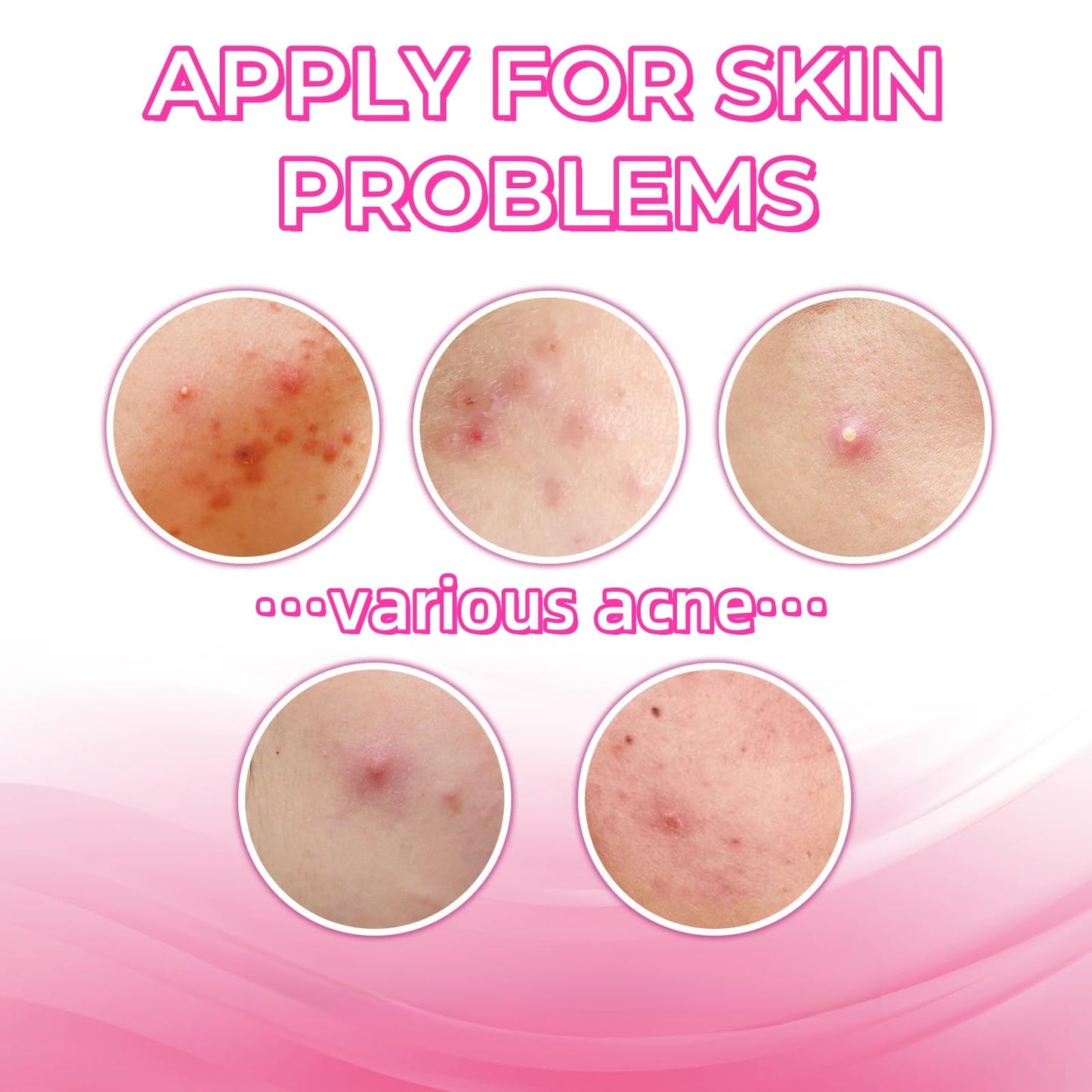 Xunzhi Acne Cream Pimple Cream for Face,Acne Treatment,Oil Control Pimple Remover Cr/eam,S/p/o/t Treatment,S/p/ot Crea/m,Acn/e Scar Treatm/ent,Anti Redness Crea/m for Face,Pim/ple Cre/am S/p/o/t Treatm/ent