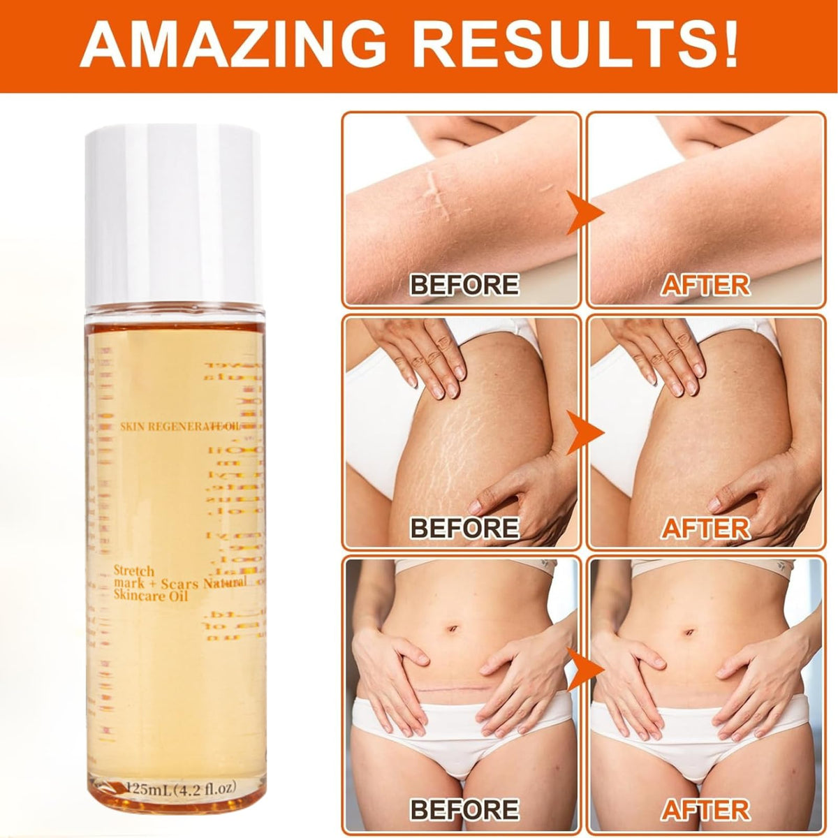 IZBEAUVO Body Skin Care Oil, Stretch Mark & Scar Oil for Women, Stretch Marks Removal Skin Regenerating Body oils, Skin Regenerate oil with Chamomile, Vitamin E, Lavender Improves Elasticity 125ML