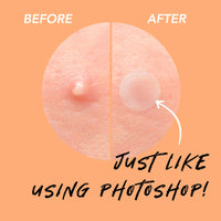 Spot Pimple Patches Aliobio Invisible Blemish Spot Cover Facial Sticker Hydrocolloid Patch Acne Stickers Spot Stickers with Two Sizes orange, 216 Count