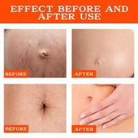 PlusBee Bio Oil Scar Treatment, Collagen Boosting Oil for Scars, Stretch Marks & Uneven Skin Tone, Skincare Serum for Pregnancy, Acne & Surgery Scars, 125ml