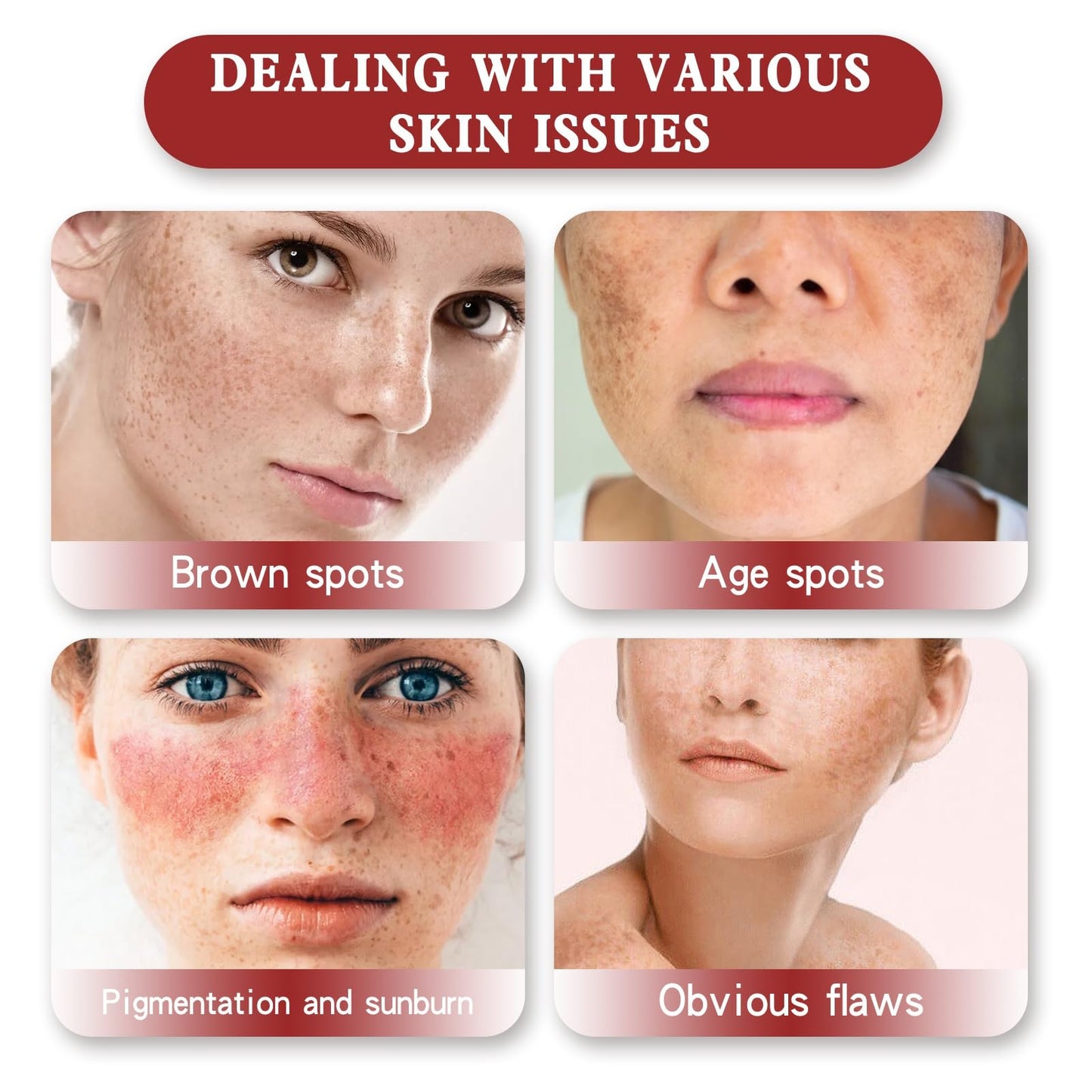 Whitening Freckle Cream,Dark Spot Remover for Face,Freckle Removal Cream,Acne Scar Removal Treatment Crea/m,Skin Lightening Cre/am for Dark Skin,Dark Spot Corrector Cr/eam,Spot C/ream for Women & Men