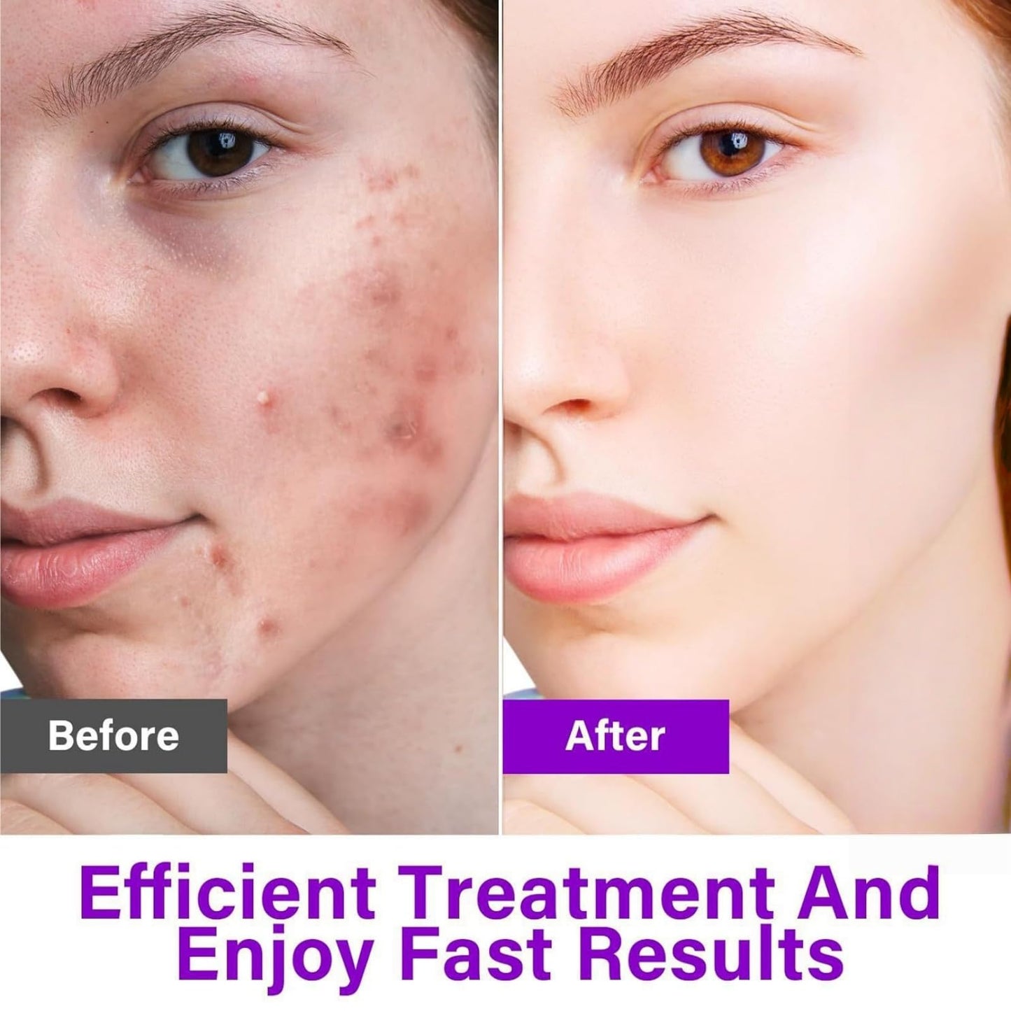 Aze/laic Aci/d 12% Face Serum,Aze/laic Ac/id for Anti Acne,Azel/aic Ac/id Face Cream,Skin Care Gel with Niacinamide,Az/elaic A/cid Cream,Ro/sacea Crea/m for Face,Dark Spot Remover,Acne Crea/m for Face