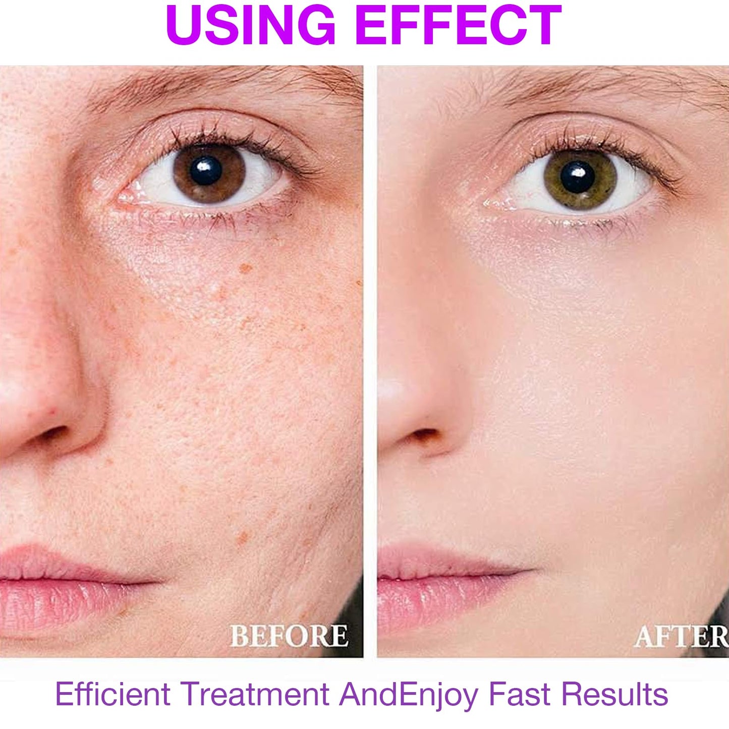 XdealCozyxc 2 PCS The Ordinary Azelaic Acid Serum, Azelaic Acid Cream Brightening Face Skin Care Pigmentation Treatment for All Skin Types