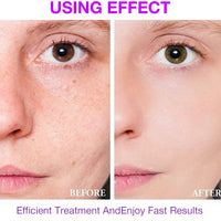 XdealCozyxc 2 PCS The Ordinary Azelaic Acid Serum, Azelaic Acid Cream Brightening Face Skin Care Pigmentation Treatment for All Skin Types