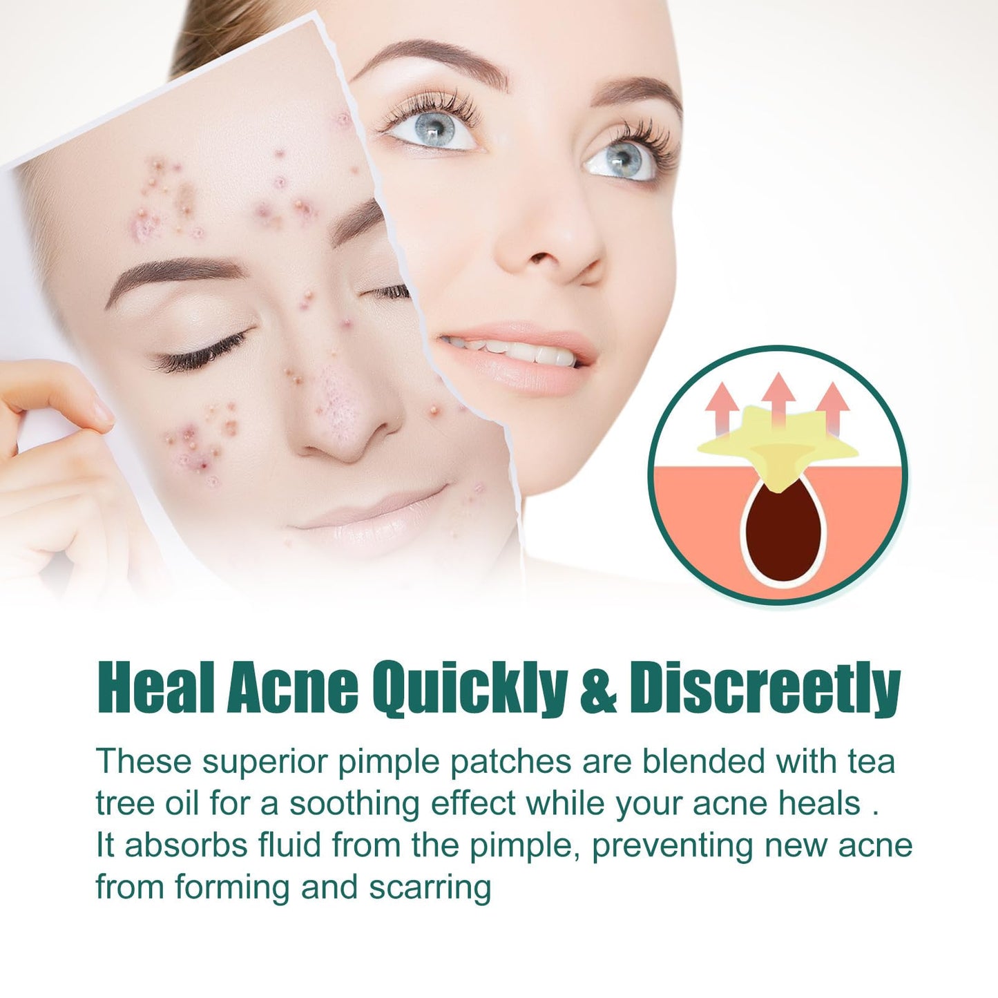 LIDOUK 12mm and 8mm spot patches, acne patches, star shaped, water-based gel patches for acne, blemishes, cyanosis, and facial acne patches (112 patches)