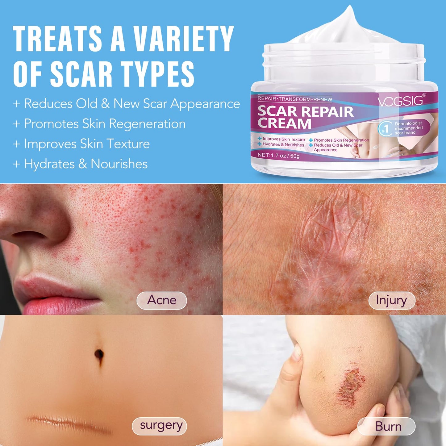 mysemgshuo 50g Advanced Scar Gel Cream, Scar Repair Cream, Scar Removal,Scar Treatment, Scar Removal Cream for C-Section, Stretch Marks, Acne, Effective for Both Old and New Scars