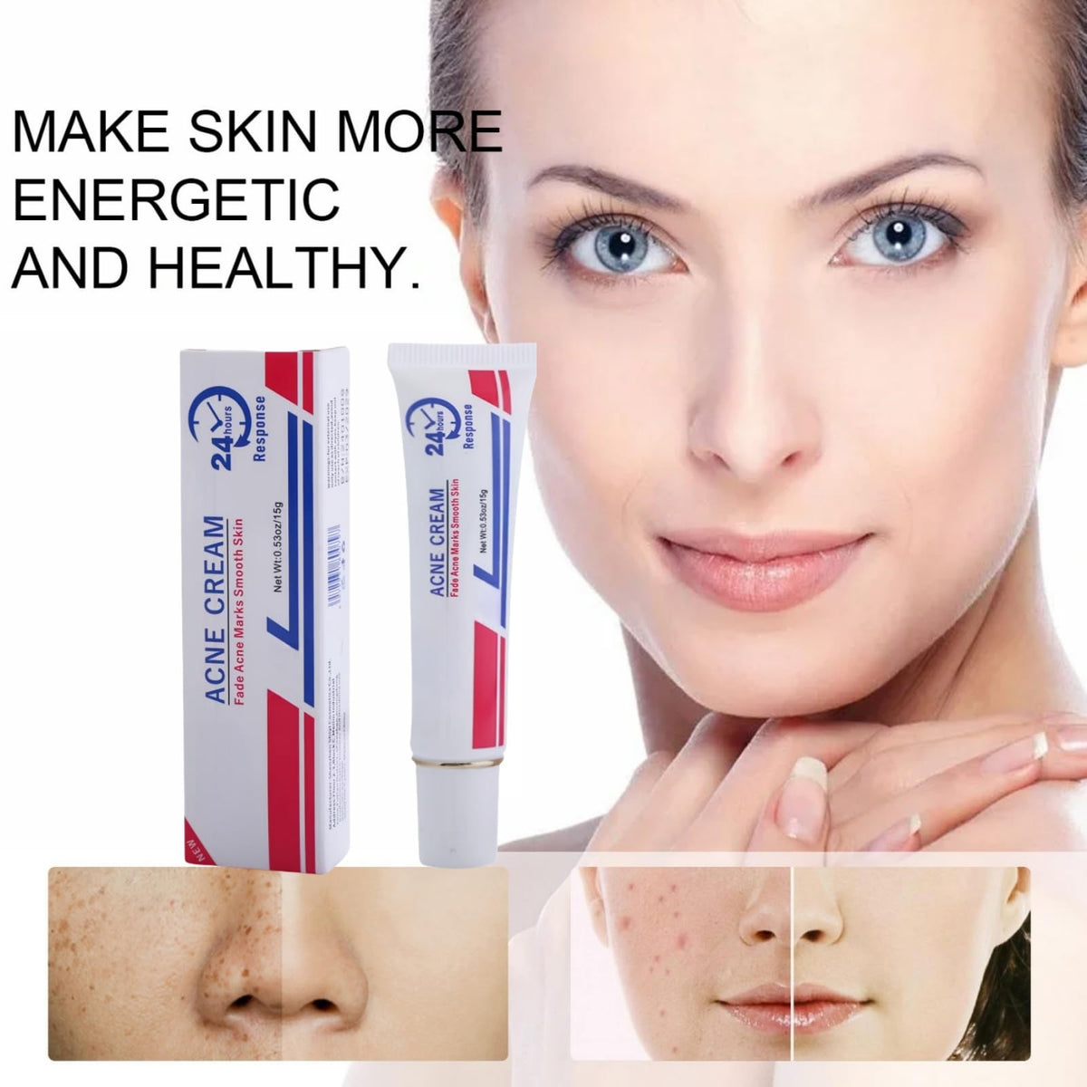 QinZiEn Acid Spot Cream,Acne Treatment for Spot Prone Skin,Acne Scar Treatment,24-Hour Spot Reduction,Acne Cream,Dark Spot Remover for Face,A/nce Scar Removal C/ream,Spot Treat/ment,15g