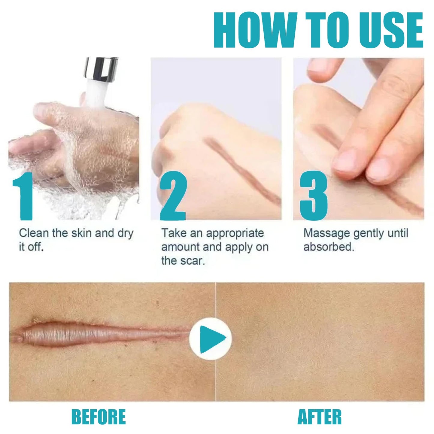 Scar Cream, Scar Removal Cream, Stretch Mark Removal Cream, Scar Erase, Skin Repair Cream for Face & Body Scar, for C-Section, Burns, Stretch Marks, Acne, Surgery, Effective for Both Old and New Scars