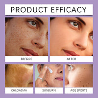 HERBENJOY Pigmentation Removal Cream, Anti-Hyperpigmentation Cream, Skin Advanced Creams, Anti-Ageing Face Hyperpigmentation Treat for All Type Skin, 20g