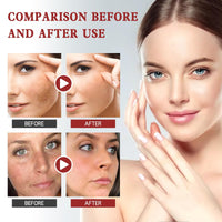 Whitening Freckle Cream,Dark Spot Remover for Face,Freckle Removal Cream,Acne Scar Removal Treatment Crea/m,Skin Lightening Cre/am for Dark Skin,Dark Spot Corrector Cr/eam,Spot C/ream for Women & Men