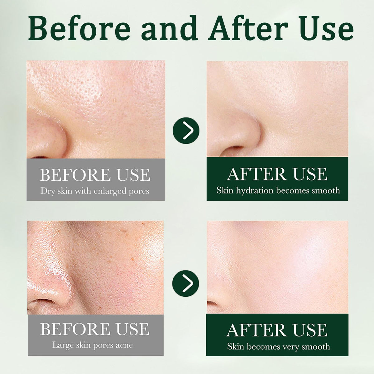 ISBEAUSOLS Tea Tree Acne Cream 50g - Spot Cream for Acne & Pimple - Dark Spot Remover for Face - Blackhead Remover Cream - Skin Care Face Cream for Women - Oil Control, Soothing and Moisturizing Pimple Cream