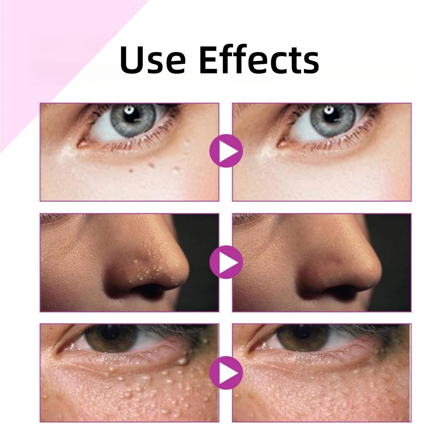 Haiyox Mi-lia Removal,Mi-lia Treatment,Mi-lia Treatment Under Eye,Mi-lia Removal Spot Care,Mil-ia Remover Serum For Face,Dark Circle Corrector,Anti Aging Anti Wrinkle,Reduces Bags,Saggy Skin & Puffy Eyes