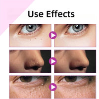 Haiyox Mi-lia Removal,Mi-lia Treatment,Mi-lia Treatment Under Eye,Mi-lia Removal Spot Care,Mil-ia Remover Serum For Face,Dark Circle Corrector,Anti Aging Anti Wrinkle,Reduces Bags,Saggy Skin & Puffy Eyes