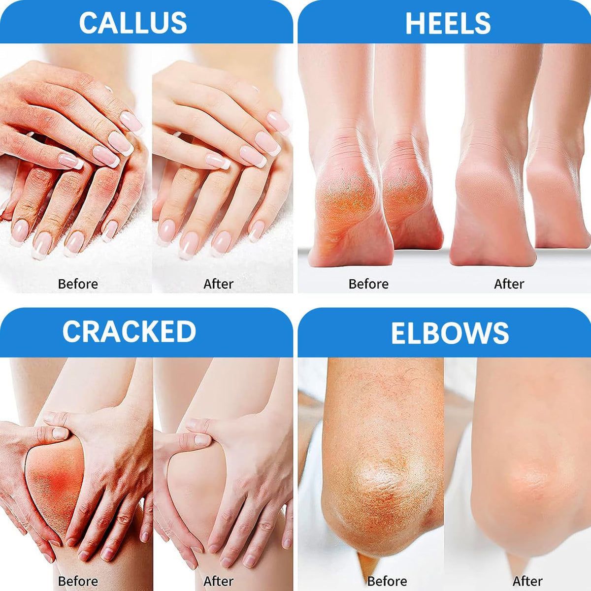 SALROAL Urea Cream 60 Percent for Feet,Urea Foot Cream for Cracked Heels and Dry Skin - Cracked Heel Cream Urea Moisturiser Plus 2% Salicylic Acid - Foot Cream for Calluses and Hard Skin (BLUE, Two Size)
