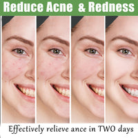Anti Acne Face Cream,Gentle Acne Cream for Acne Prone Skin,Anti Acne Removal Cream with Plant Extract,Moisturiser Face Cream for Acne Mark,Fade Acne Mark & Calm Acne Redness,Scar Removal Cream