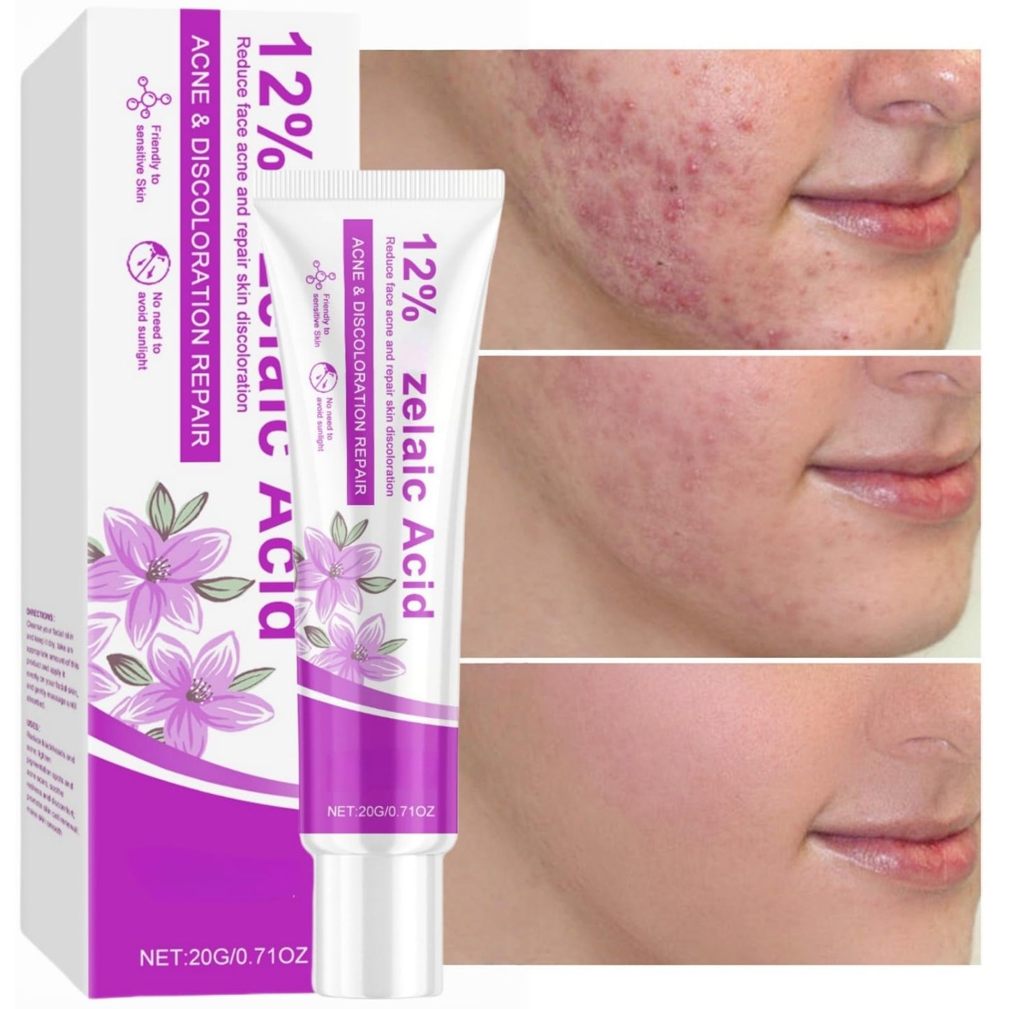 Acid 12% Facial Serum,Anti Acne Cream Face Serum,Aze/laic Aci/d for Anti Acne,A/cid Face Spot Treatment,Night Cr/eam Face Moisturiser,Skin Care Gel, A cne C/ream Skin Care,Acid Serum