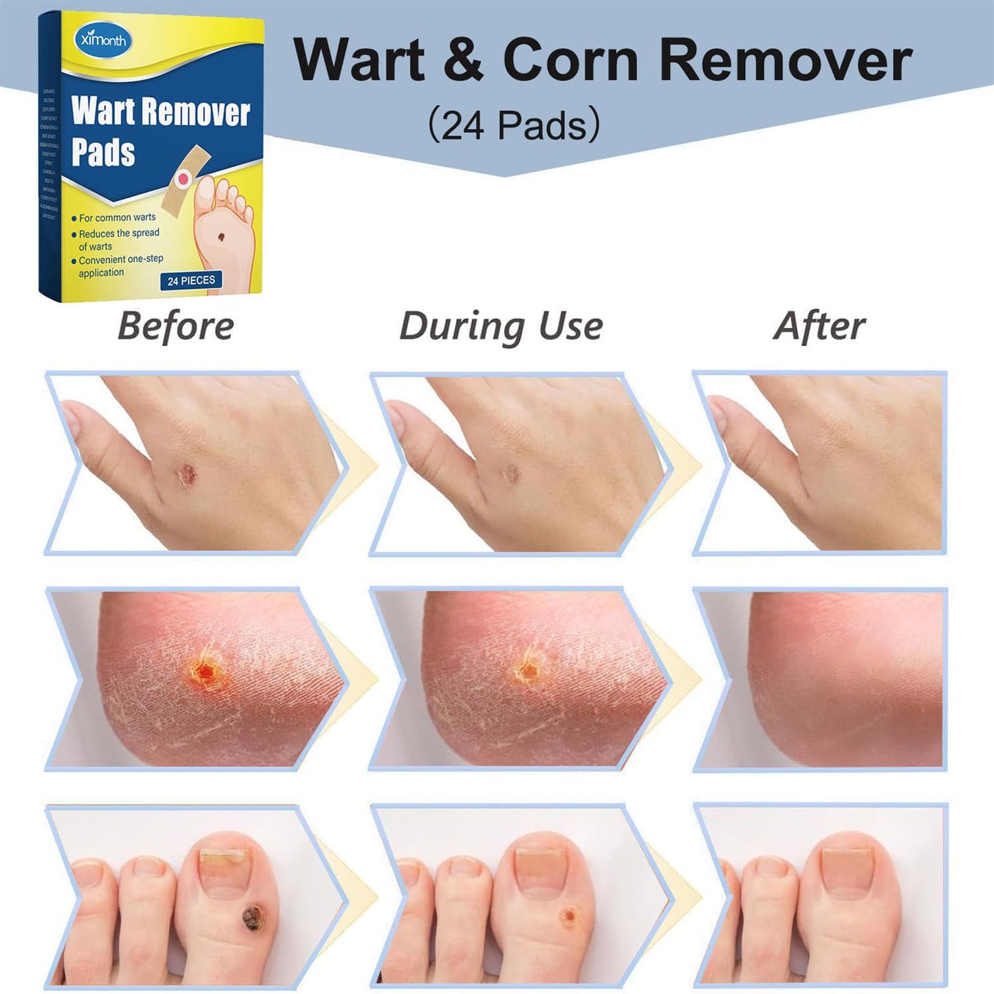 mercham Wart Remover & Verruca Treatment, 24 Pads Corn Remover Pads for Feet, Hands, Gentle & Safe on Skin, Fast & Pain Relief, Wart Treatment Plasters Effective for Kids Adults