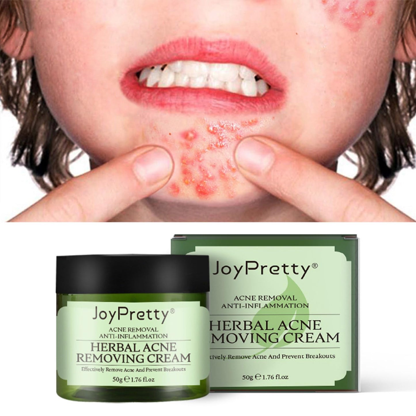 QEUTKEZS Herbal Acne Removing Cream,Professionally Remove Acne Marks,Gently Moisturize,Refreshing & Not Greasy,Improving Sensitive Skin Prone to Acne,Acne Scar Cream & Pimple Remover For All Skin Types