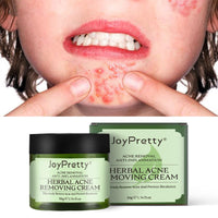 QEUTKEZS Herbal Acne Removing Cream,Professionally Remove Acne Marks,Gently Moisturize,Refreshing & Not Greasy,Improving Sensitive Skin Prone to Acne,Acne Scar Cream & Pimple Remover For All Skin Types