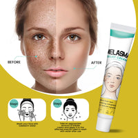 MEITREND Melasma Treatment For Face,Dark Spot Remover for Face & Body, Pigmentation Removal Cream,Corrector For Age Spots Sun Spots Freckles Melasma Brown Spots,Freckle Removal Cream