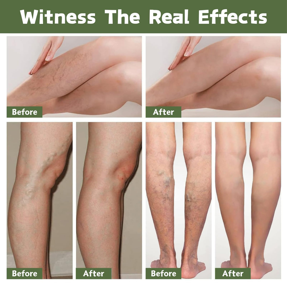 ISBEAUSOLS 2PCS Edema Balm for Legs, Soothing Miracle Balm to Reduce Swelling in Feet and Legs, Var-icose V-eins Cream, Body Cream with Natural Ingredients, Vegan Skincare, 30g × 2