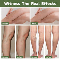 ISBEAUSOLS 2PCS Edema Balm for Legs, Soothing Miracle Balm to Reduce Swelling in Feet and Legs, Var-icose V-eins Cream, Body Cream with Natural Ingredients, Vegan Skincare, 30g × 2