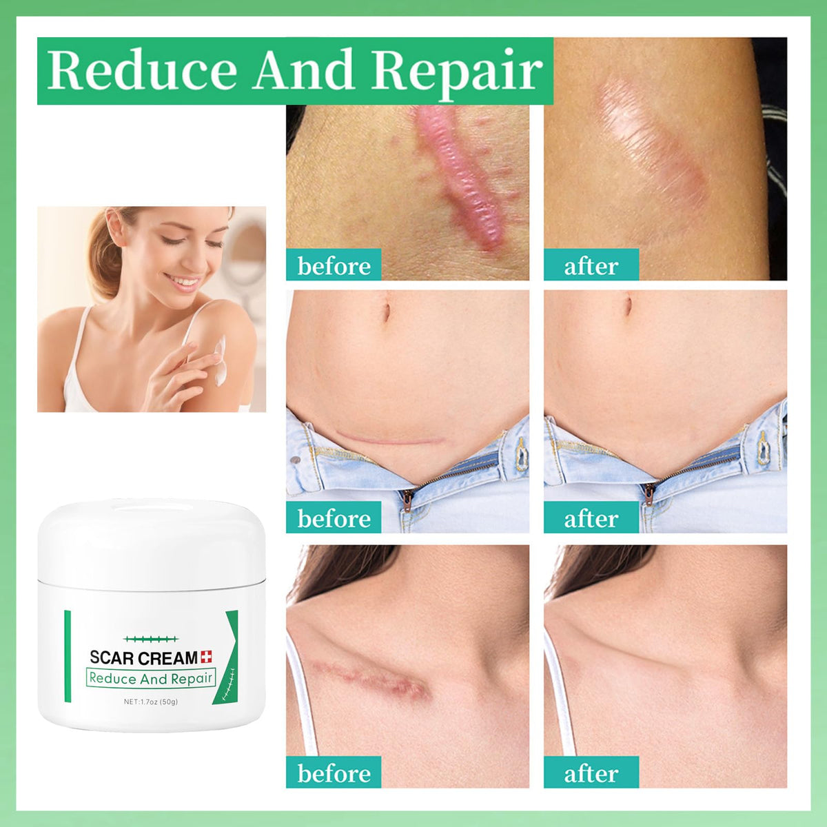 MINSHZEE Scar Removal Cream for Face & Body - Treatment for New Scars, Stretch Marks, Acne Spots & C-Sections Treatment Cream, 50g, Natural Formula for Face and Body, Reduces Old and New Scars