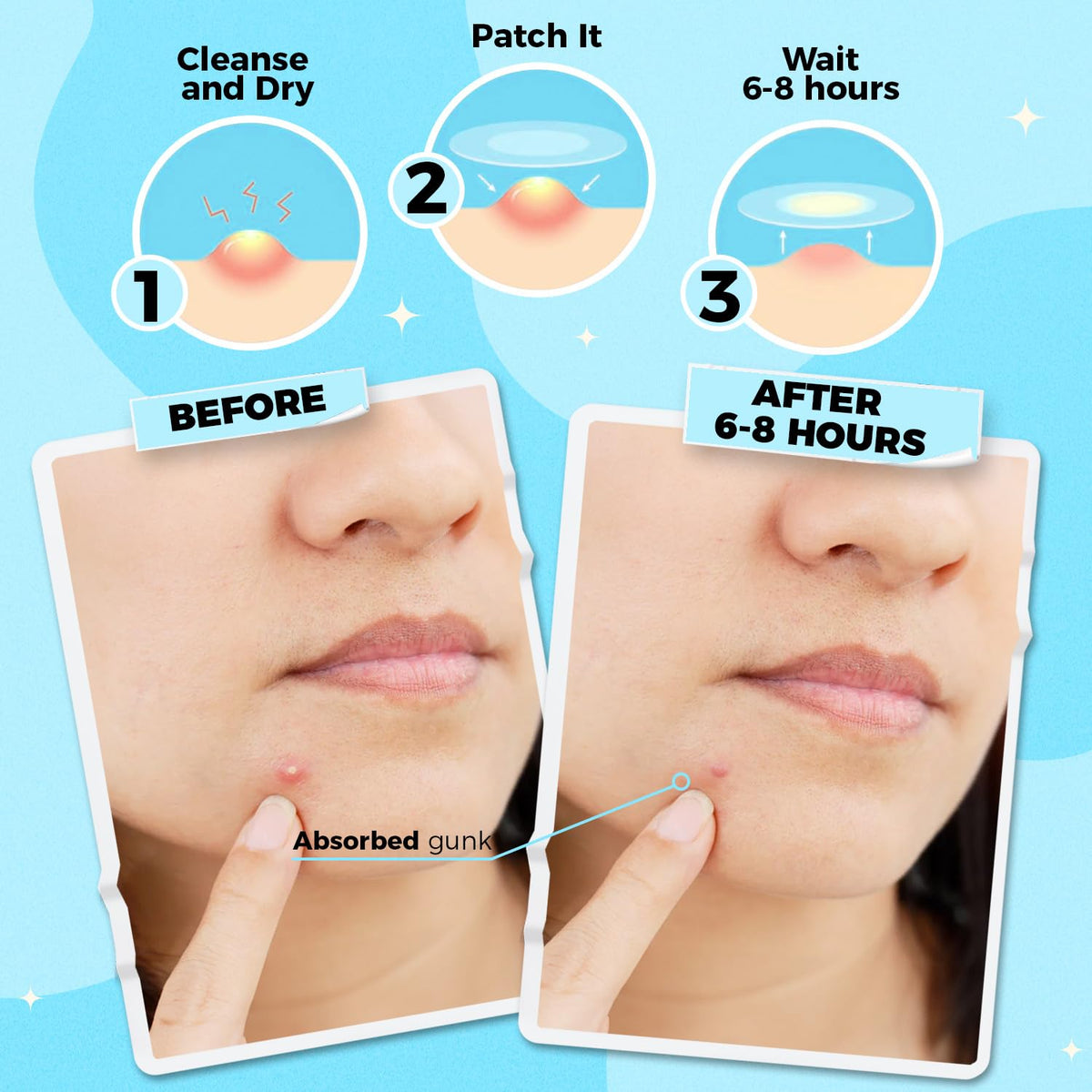 PurePatch Pimple Patches - 96 Hydrocolloid Spot Patches with Salicylic Acid & Tea Tree Oil, 3 Sizes, Night & Day Acne Treatment Pack, Ultra Thin Day & Thick Night, Easy Removal Perforated Sheets