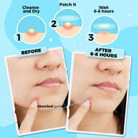 PurePatch Pimple Patches - 96 Hydrocolloid Spot Patches with Salicylic Acid & Tea Tree Oil, 3 Sizes, Night & Day Acne Treatment Pack, Ultra Thin Day & Thick Night, Easy Removal Perforated Sheets