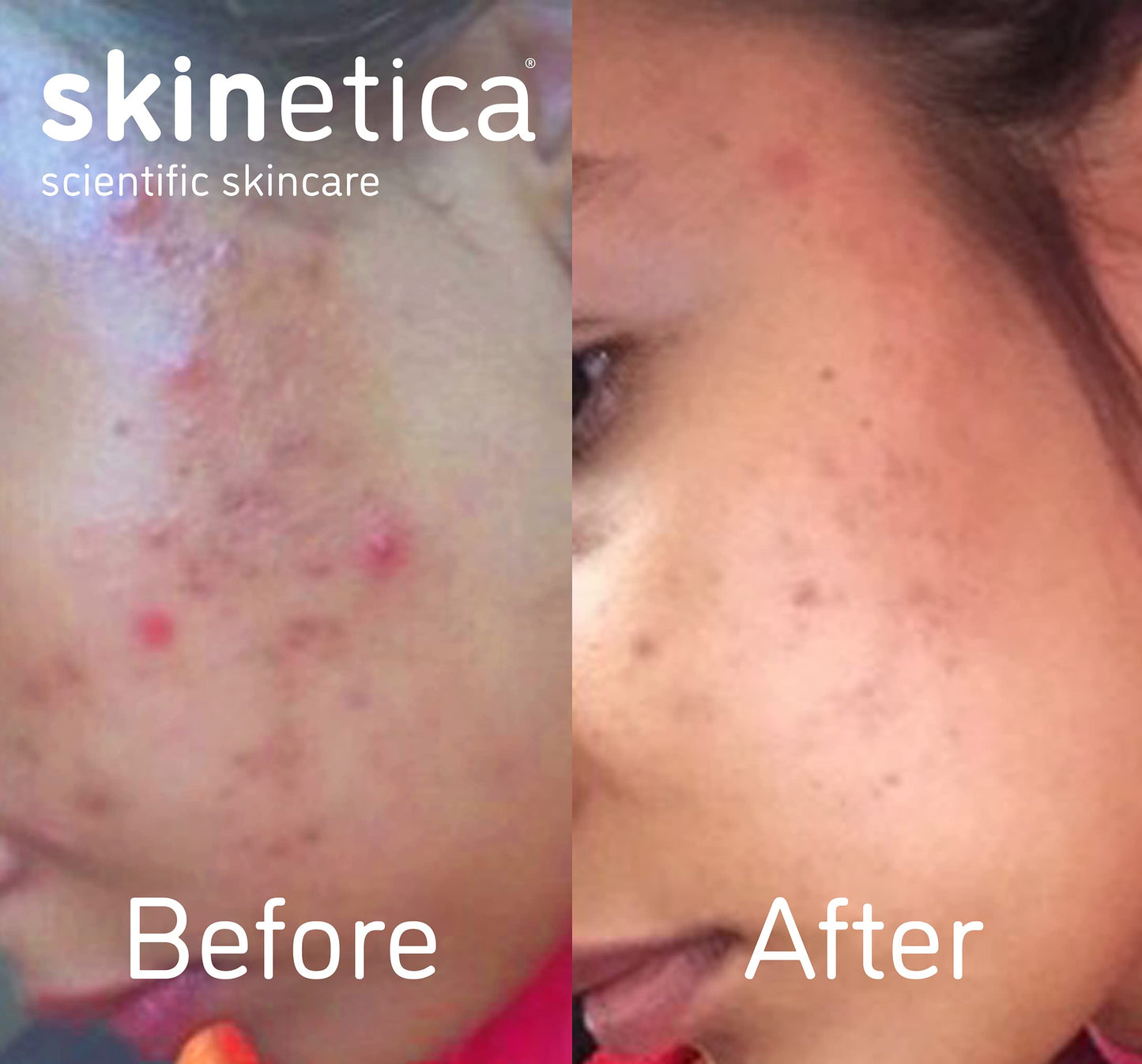 Skinetica Quintessence Face Toner for Acne, Spots and Blemishes 100ml | No Harsh Chemical, Paraben-Free & Vegan Friendly Toner for Face | Refreshing & Non-Irritating Skin Toner for Sensitive Skin