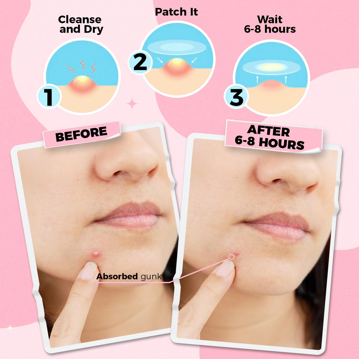 PurePatch Pimple Patches - Breakout Pack - 96Circle,10Nose, 10Chin. Hydrocolloid Spot Patches with Salicylic Acid & Tea Tree Oil, Variety Acne Treatment Pack, Ultra Thin Day & Thick Night