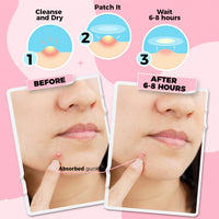 PurePatch Pimple Patches - Breakout Pack - 96Circle,10Nose, 10Chin. Hydrocolloid Spot Patches with Salicylic Acid & Tea Tree Oil, Variety Acne Treatment Pack, Ultra Thin Day & Thick Night