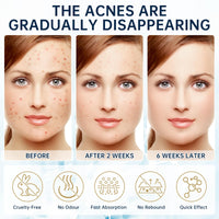 Azelaic Acid face serum cream for Redness Relief,Dark Spots,Azelaic Acid Acne Cream with Niacinamide & Vitamin C,Acid 14% Facial Serum Balance Excess Sebum & Soothe Irritation,30ml,2pcs