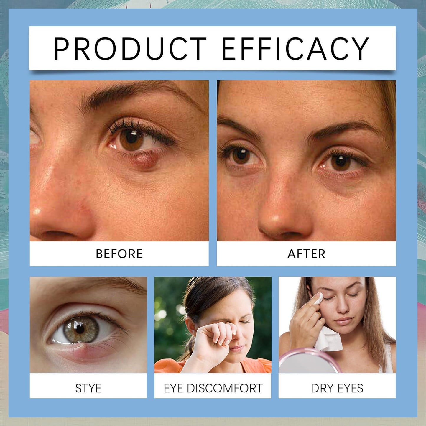 MINSHZEE Chalazion and Blepharitis Eye Cream - soothes eyelid swelling, redness and irritation - treats blisters, bags and dry chalazion - a gentle eye cream for daily eye care 2pcs