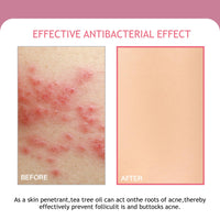 Butt Acne Cream 100ml, Butt Acne Treatment for Women with Tea Tree Oil, Body Acne Lotion for Back and Thighs, Acne Scar Cream and Pimple Spot Treatment for Smooth Clear Skin