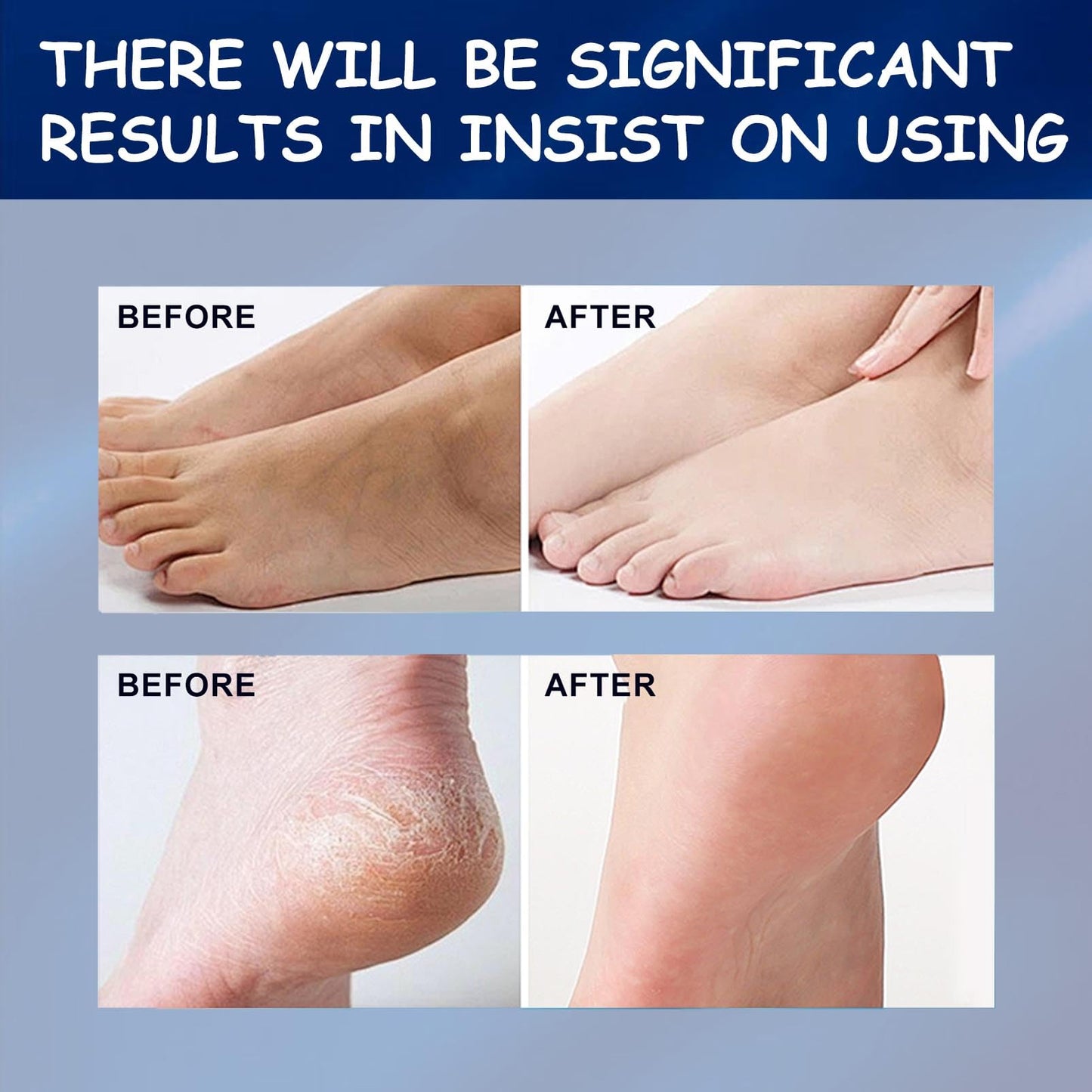 ISBEAUSOLS 42% Urea Foot Cream - Urea Cream - Foot Cream For Cracked Heels And Dry Skin - Cracked Heel Repair Cream - For Feet, Hands, Elbows, Nails & Knees - Moisturizing, Callus Remover and Soften